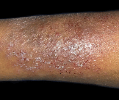 best eczema creams for african american skin