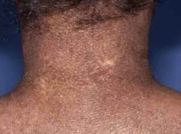 best creams for eczema on African American skin - neck and upper back eczema on black skin