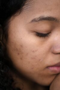 best organic facial cleanser for acne prone skin - a pic of a girl with acne. Acne is shown on 1 cheek