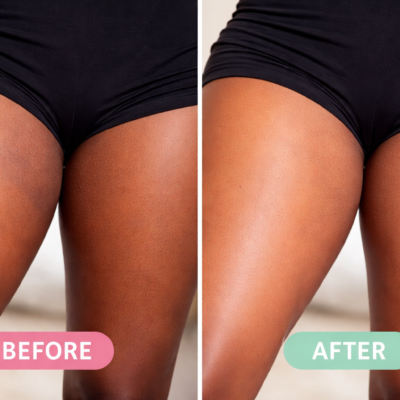 Side-by-side before and after image of a woman’s inner thighs showing reduction in dark spots and uneven skin tone, with smoother and more even-looking skin in the after result.