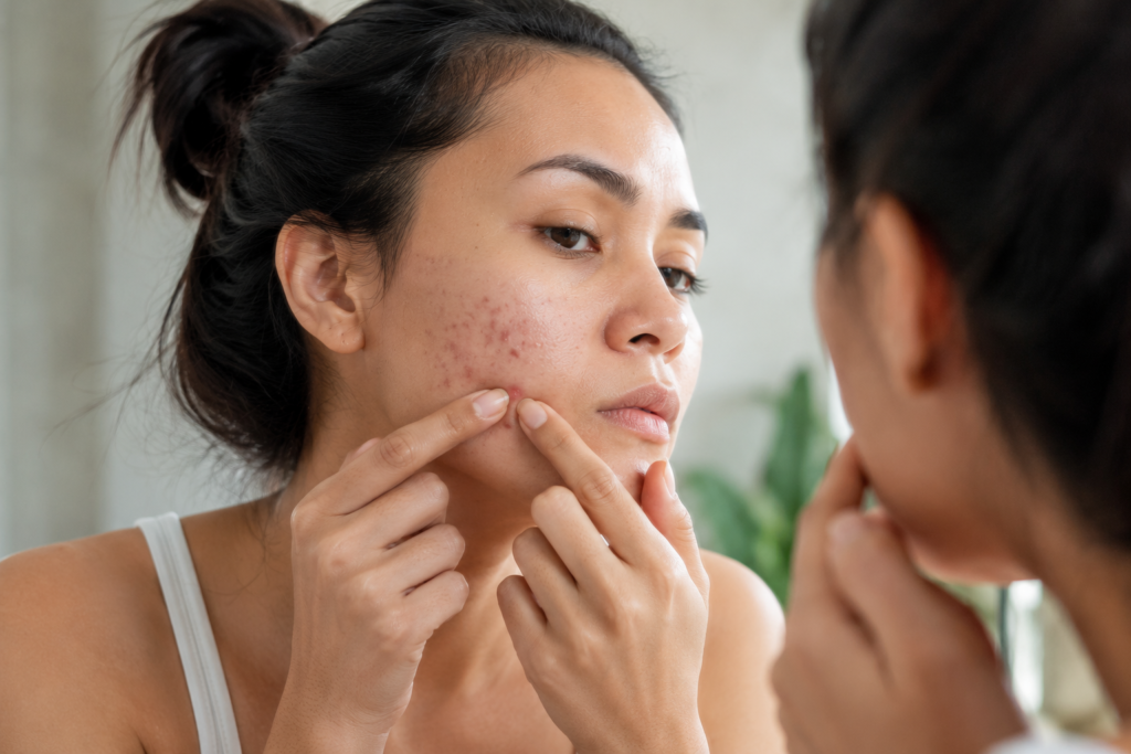 Skincare image showing a woman examining and picking at an acne breakout on her cheek while looking into a bathroom mirror. Red blemishes and early post-acne marks are visible on her skin, illustrating how touching or popping pimples can lead to irritation, inflammation, dark spots, and hyperpigmentation. Soft natural lighting and a clean bathroom setting create an authentic skincare-focused scene.